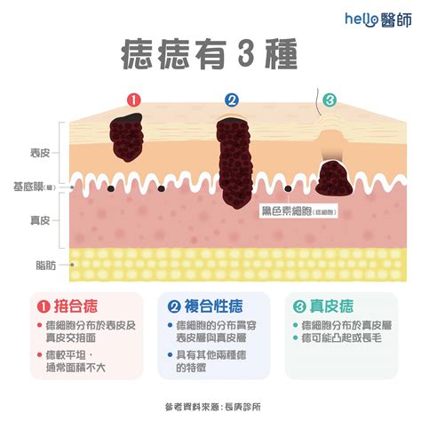 凸痣長毛|痣變大、痣多或長毛會變皮膚癌？認識痣的形成與原因